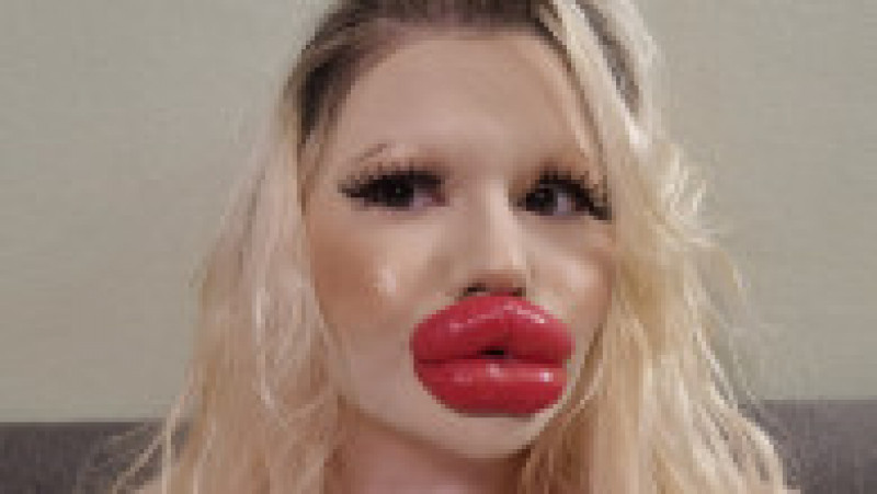 Andrea Ivanova, o femeie din Bulgaria cunoscută pe internet ca fiind deținătoarea "celor mai mari buze din lume", a recurs la noi injecții pentru echilibra trăsăturile feței. Sursa foto: Profimedia Images | Poza 3 din 9