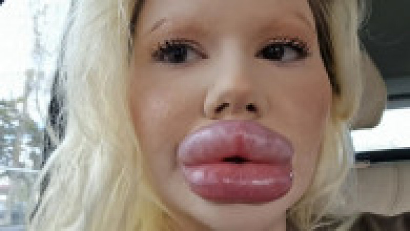 Andrea Ivanova, o femeie din Bulgaria cunoscută pe internet ca fiind deținătoarea "celor mai mari buze din lume", a recurs la noi injecții pentru echilibra trăsăturile feței. Sursa foto: Profimedia Images | Poza 9 din 9